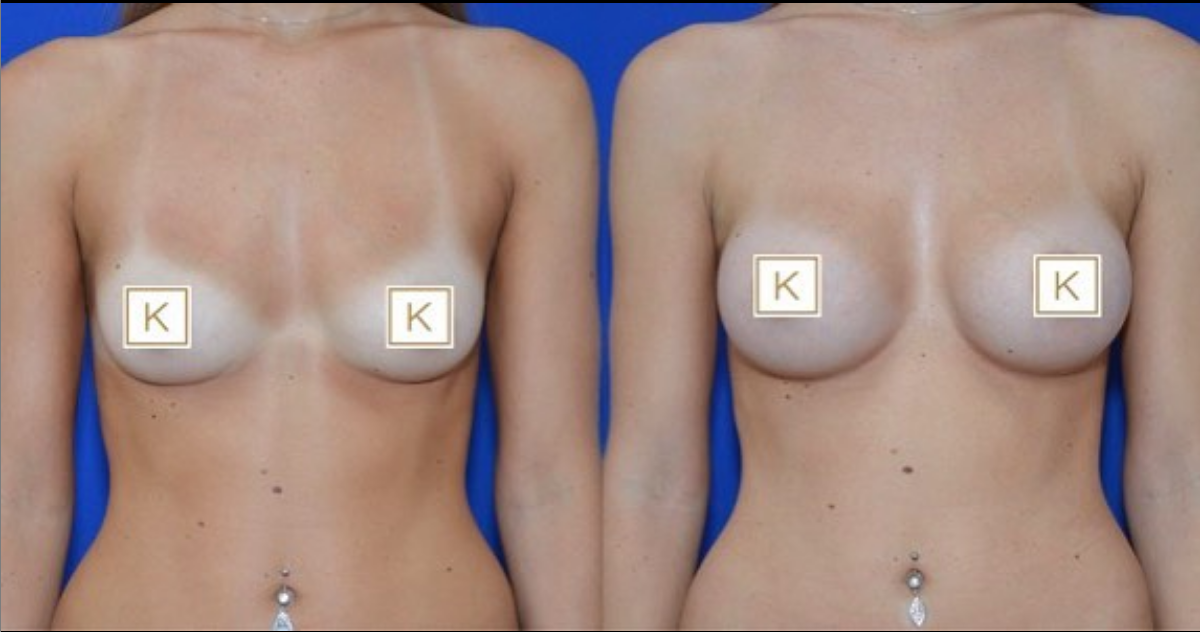 Before and after photos of a breast augmentation at the Kuzbari Centre