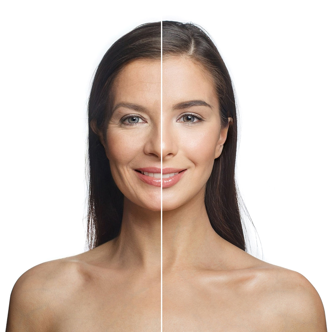 Facial changes after substantial weight loss