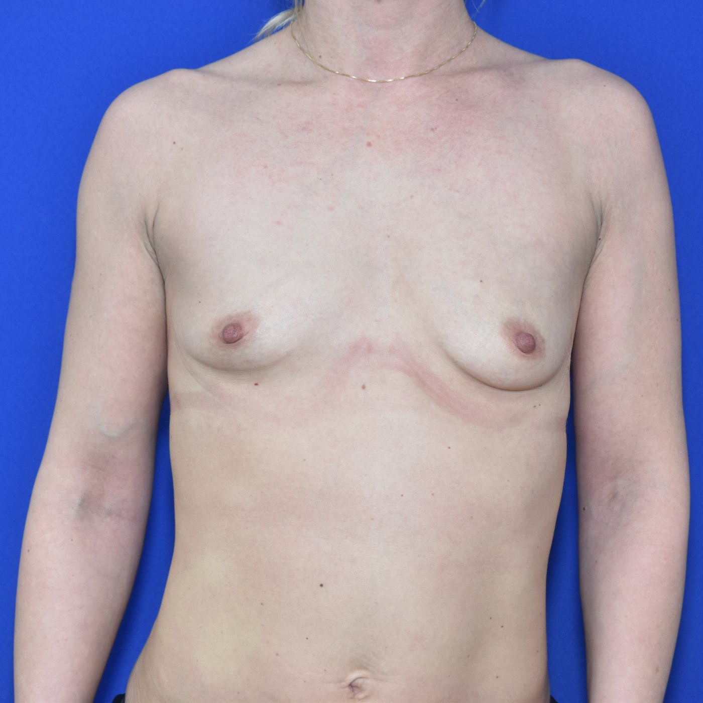 Bruststraffung mit Implantat vorher — Fall 26074, 34 Jahre