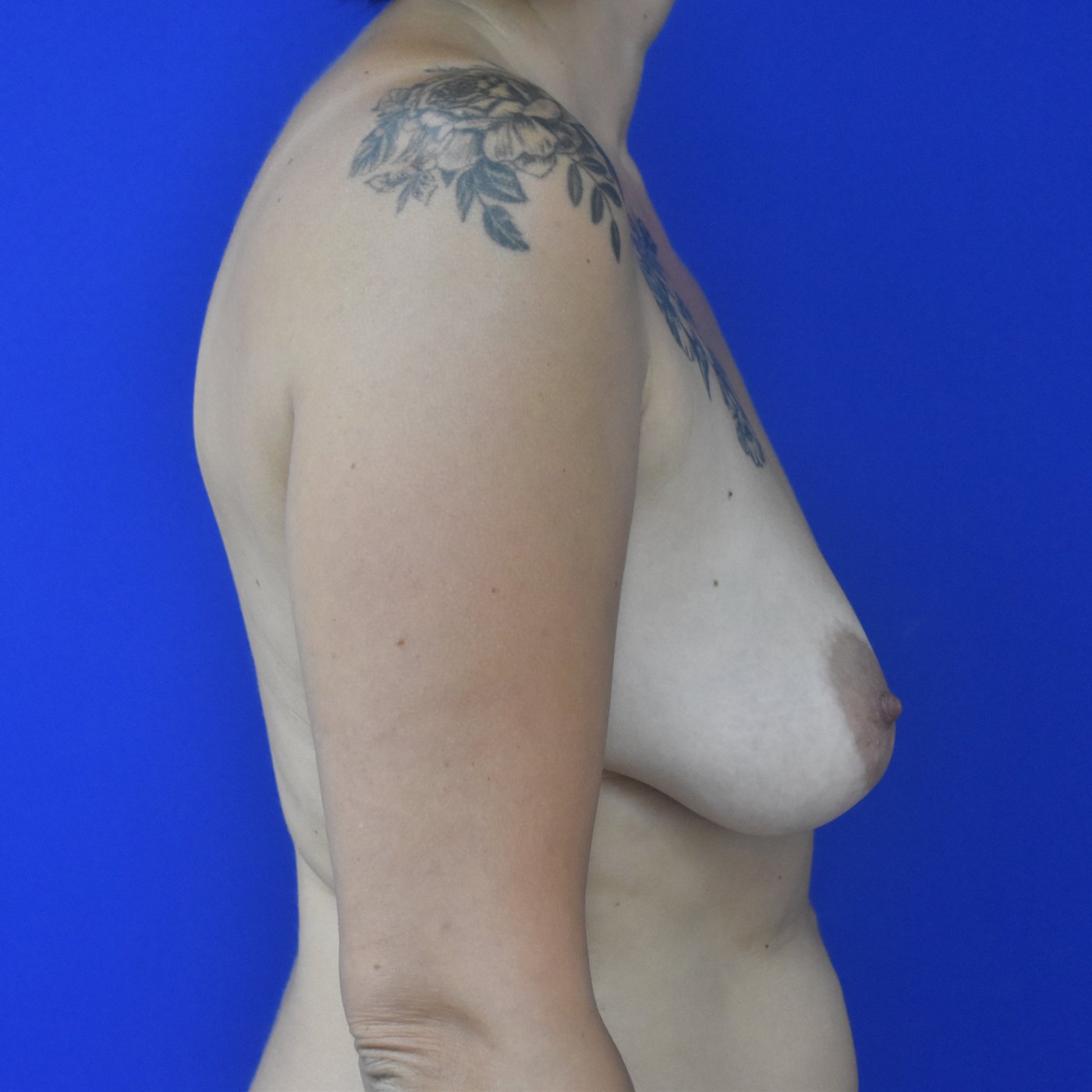 Bruststraffung mit Implantat vorher — Fall 32300, 40 Jahre (Ansicht 2)