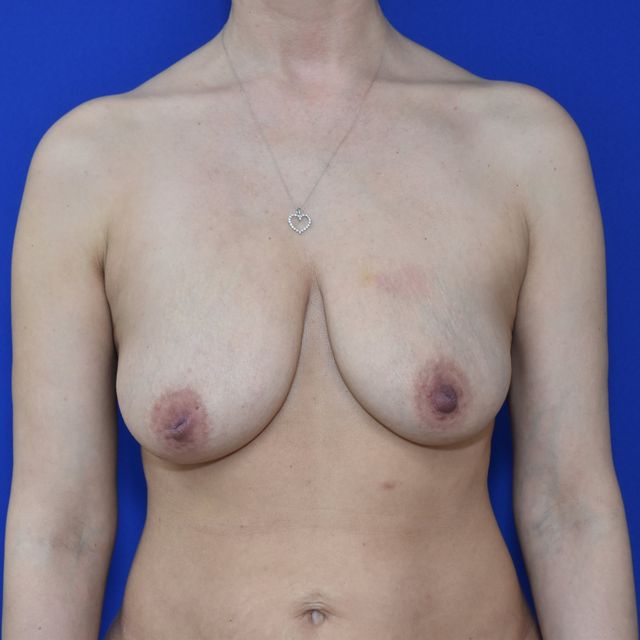 Bruststraffung mit Implantat vorher — Fall 35339, 40 Jahre (Ansicht 1)