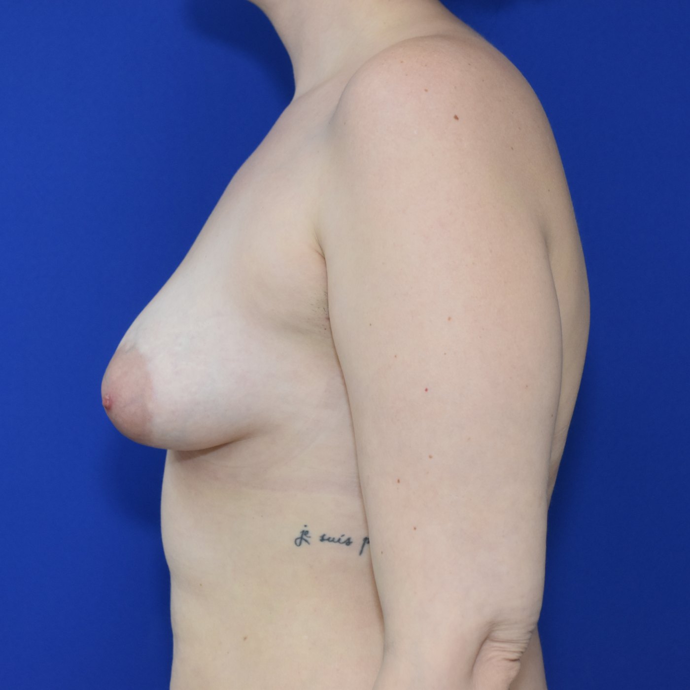 Bruststraffung mit Implantat vorher — Fall 38753, 36 Jahre (Ansicht 2)