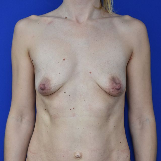 Bruststraffung mit Implantat vorher — Fall 39289, 38 Jahre (Ansicht 1)