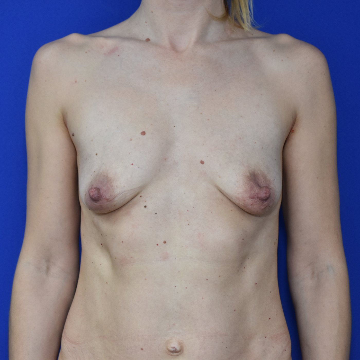 Bruststraffung mit Implantat vorher — Fall 39289, 38 Jahre (Ansicht 1)