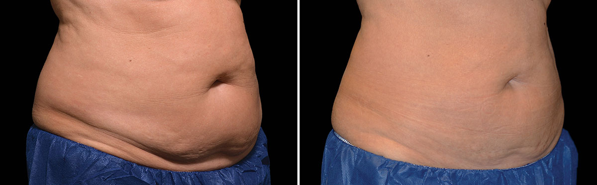 Coolsculpting Before & After
