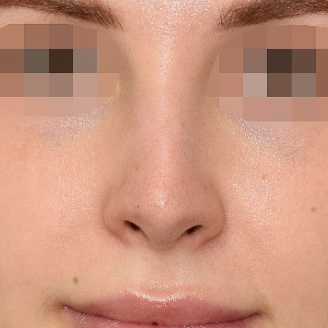 Nasenkorrektur nachher, Frontalansicht — Fall 18154, 25 Jahre