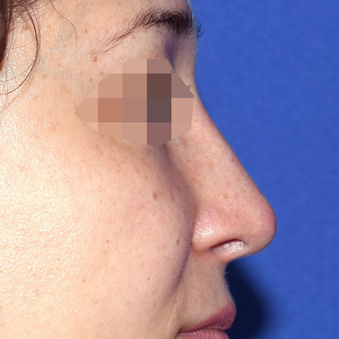 Nasenkorrektur nachher, Profilansicht: Nasenhöcker — Fall 6350, 33 Jahre