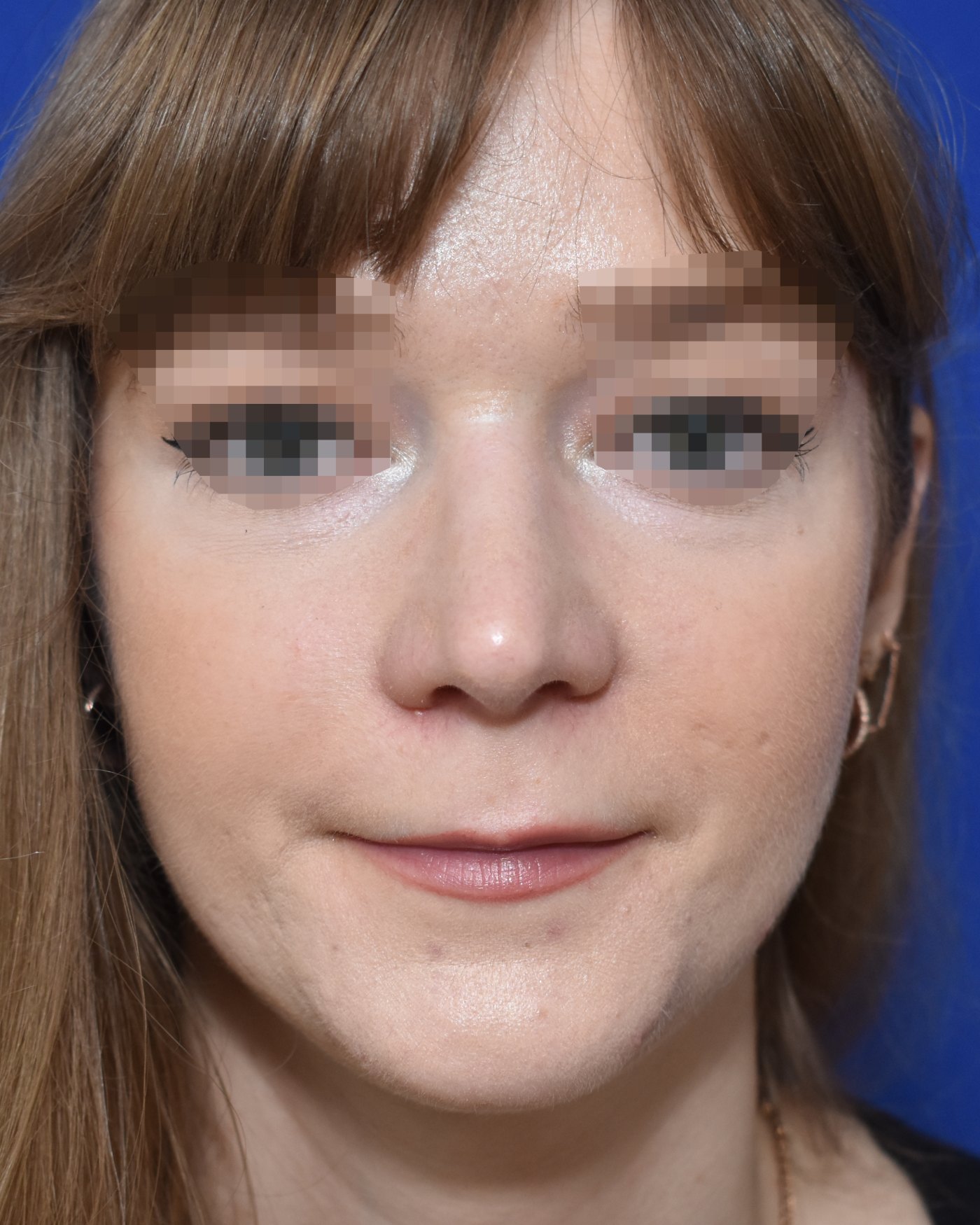 Nasenkorrektur nachher, Frontalansicht — Fall 90012, 33 Jahre
