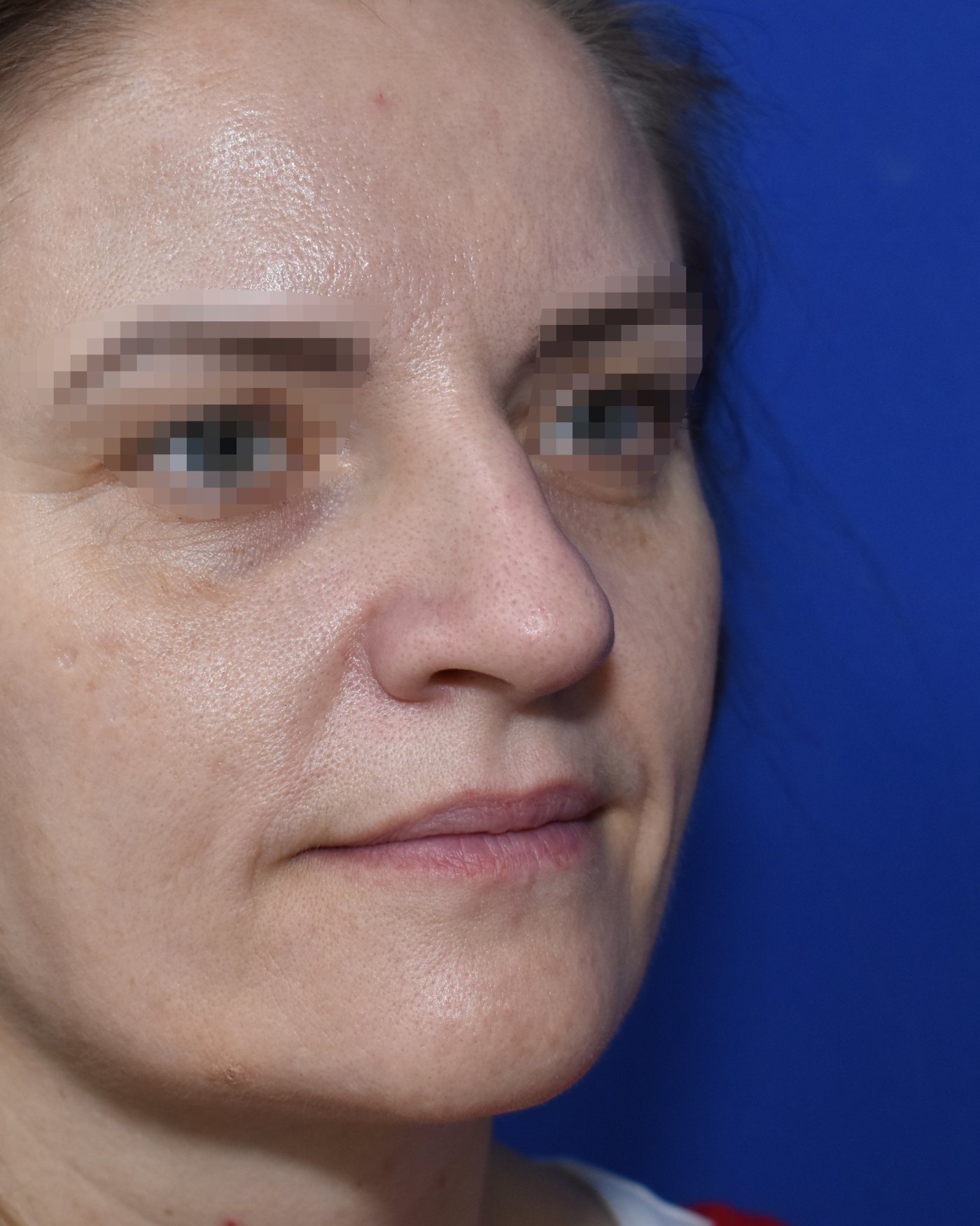 Nasenkorrektur vorher, Halbprofil (45 Grad): Nasenhöcker, Nasenspitze, Breite Nase, Nasenatmung — Fall 90021, 43 Jahre