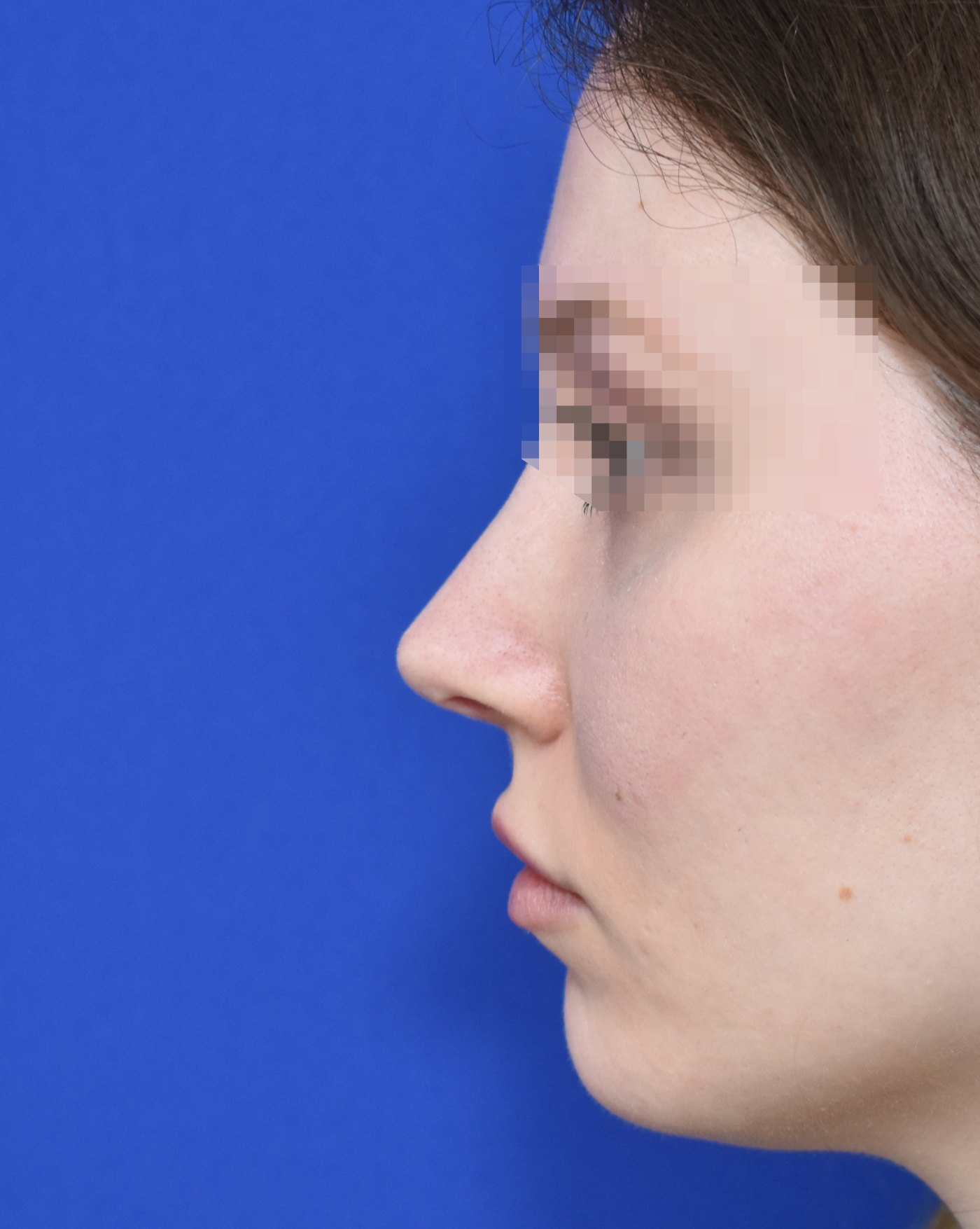 Nasenkorrektur nachher, Profilansicht: Nasenspitze, Breite Nase, Zu große Nase — Fall 90026, 27 Jahre