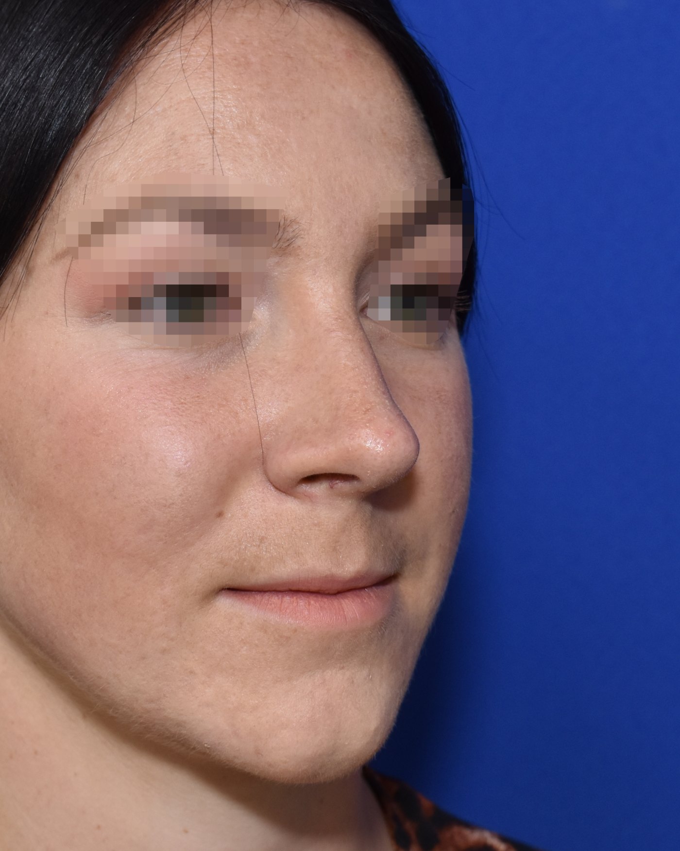 Nasenkorrektur nachher, Halbprofil (45 Grad) — Fall 90029, 27 Jahre